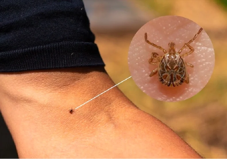 Febre maculosa em Jundiaí: óbito confirmado reforça alerta de prevenção