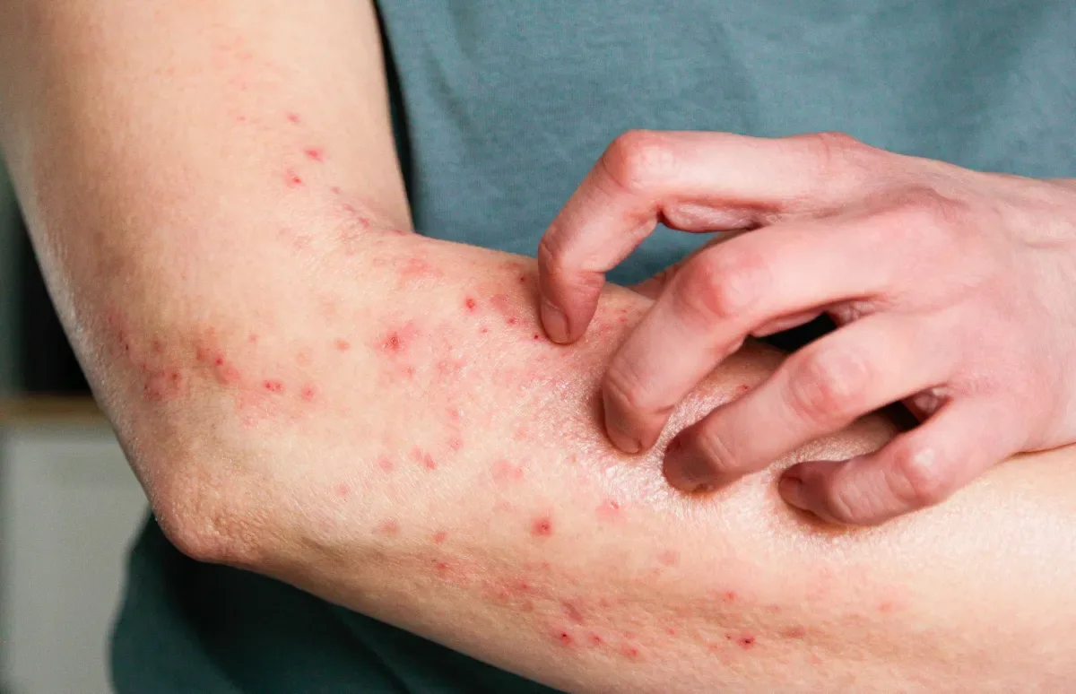 Mpox em Jundiaí 2026: cidade confirma primeiro caso e reforça prevenção